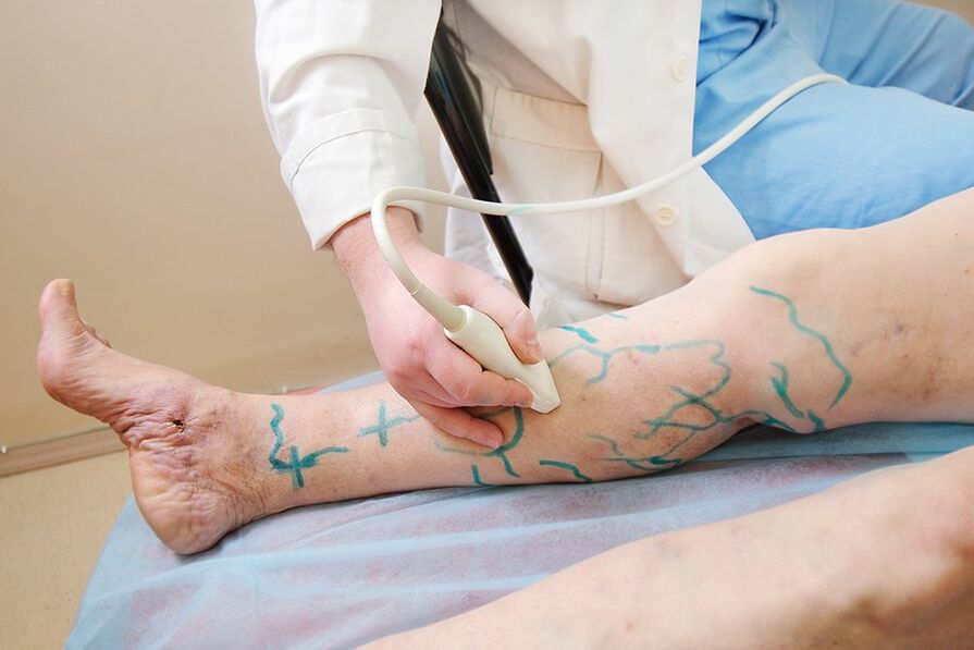 Preparazione per miniflebectomia - marcatura sui perforatori della parte inferiore della gamba, esecuzione dell'ecografia